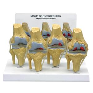 미제 무릎관절염 4단계모형 고급형 교육용 G110