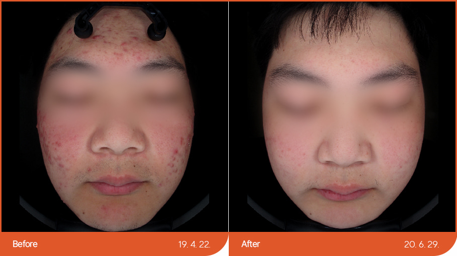 痤疮/疤痕治疗