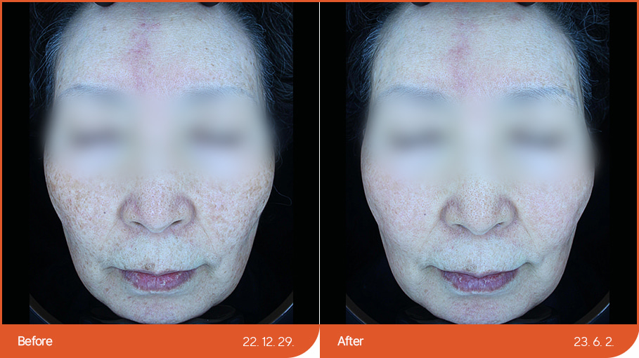 色素性疾病治疗