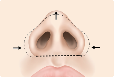 Alar Base Reduction