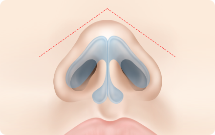 Nose Shape Correction