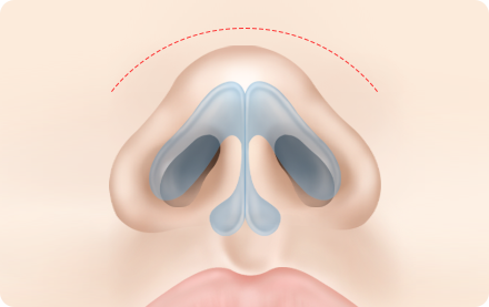 Nose Shape Correction