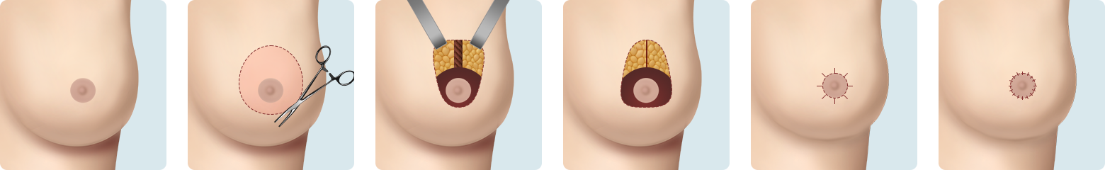 Breast Reduction