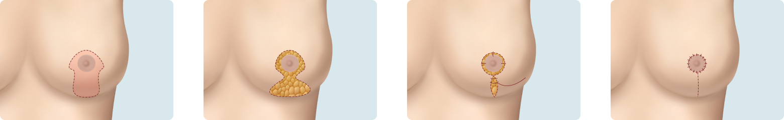 Breast Reduction