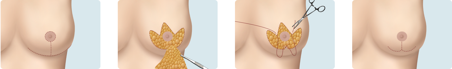 Breast Reduction
