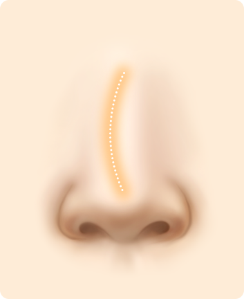 Nose Shape Correction