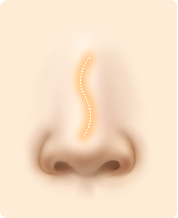 Nose Shape Correction