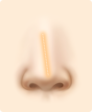 Nose Shape Correction