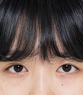 Ptosis Correction