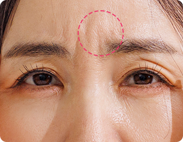 Ptosis Correction