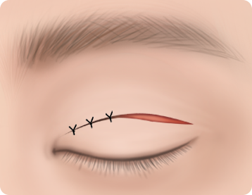 Ptosis Correction
