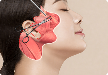 Full facelift