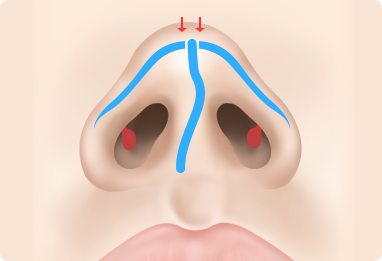 Functional Rhinoplasty