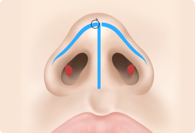 Functional Rhinoplasty