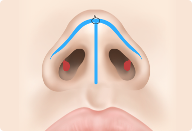 Functional Rhinoplasty