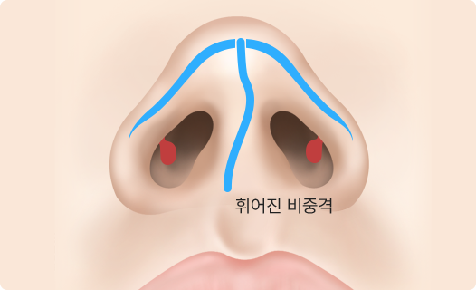 Functional Rhinoplasty
