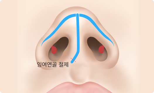Functional Rhinoplasty