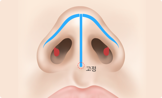 Functional Rhinoplasty