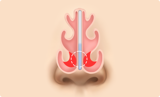 Functional Rhinoplasty