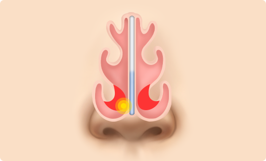 Functional Rhinoplasty
