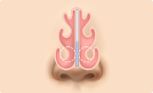 Functional Rhinoplasty