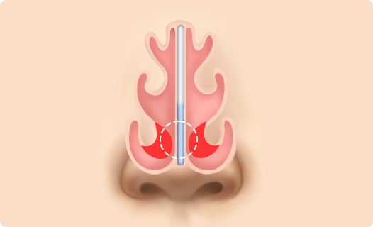 Functional Rhinoplasty