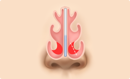 Functional Rhinoplasty