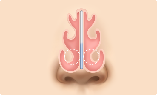 Functional Rhinoplasty