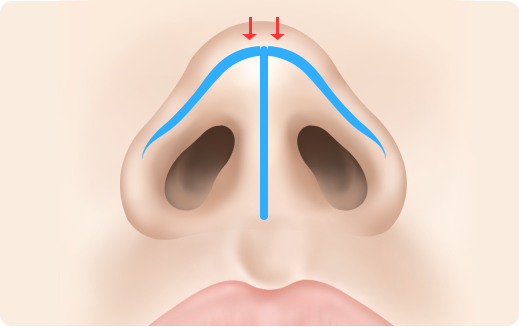 Functional Rhinoplasty