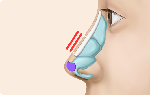 Functional Rhinoplasty