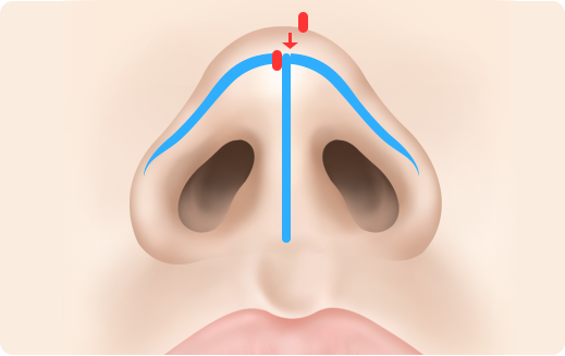 Functional Rhinoplasty