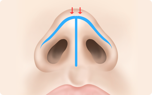 Functional Rhinoplasty