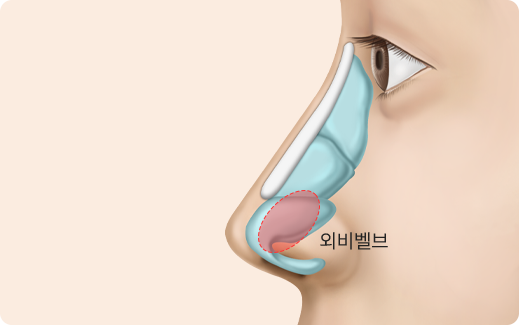 Functional Rhinoplasty