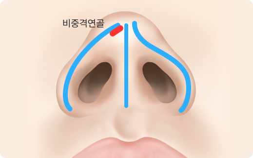 Functional Rhinoplasty