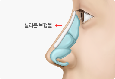 Nose Shape Correction