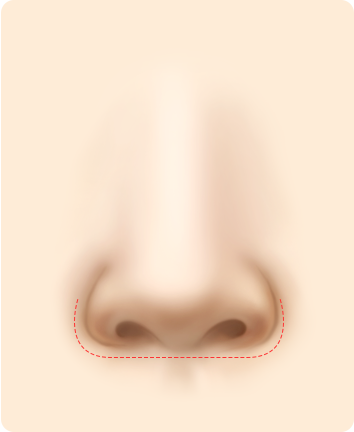 Alar Base Reduction