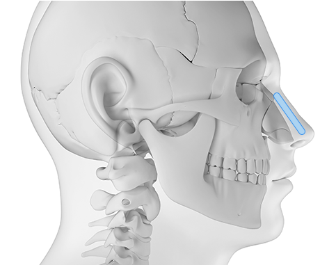 Functional Rhinoplasty