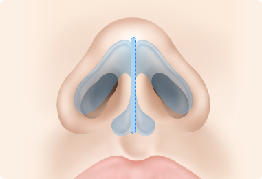 Nose Shape Correction