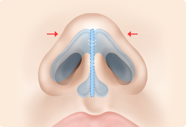 Nose Shape Correction