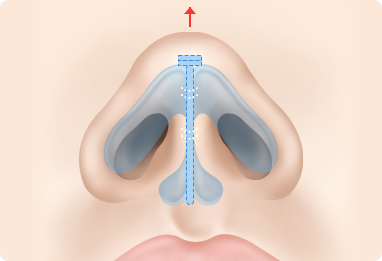 Nose Shape Correction