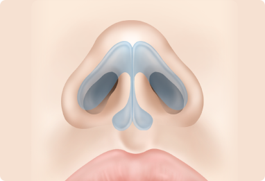 Nose Shape Correction