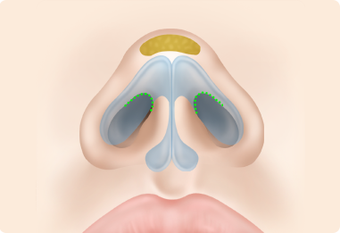 Nose Shape Correction