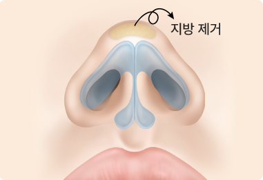 Nose Shape Correction