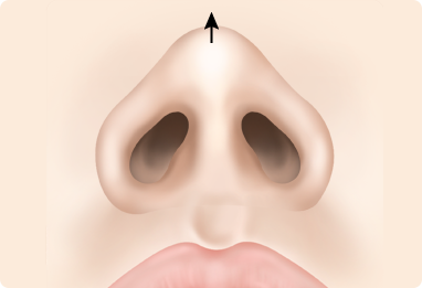 Nose Shape Correction