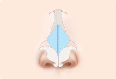 Nose Shape Correction