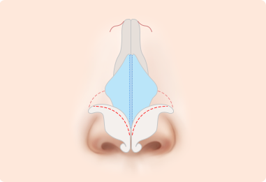 Nose Shape Correction