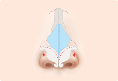 Nose Shape Correction