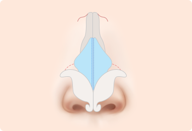 Nose Shape Correction