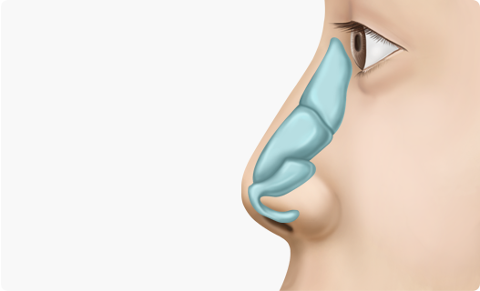 Nose Shape Correction