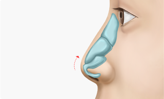 Nose Shape Correction
